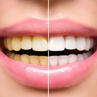 HiSmile V34 Colour Corrector – Purple Teeth Whitening Serum